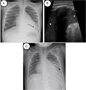 Patient 2. (A) Initial chest radiography before lung recruitment. Coalescent opacities in left lower lobe (black arrow). No pleural effusion observed. (B) Lung ultrasound image before VNI lung recruitment. Tissular pattern suggesting consolidation (white star). No air bronchogram is observed. The lung partner is similar to the spleen pattern (white point). White arrow shows the doble-rail image of the diaphragm. (C) Chest-X radiography after recruitment. Area of hazy with increased lung opacity (black star).