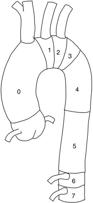 Clasificación de las zonas proximales de anclaje de las endoprótesis en la aorta torácica descendente.