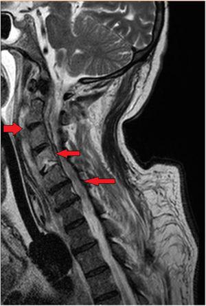 Disminución de la colección prevertebral y del componente inflamatorio epidural, sin evidencia de la colección (flechas). También se señala mediante flechas la persistencia de la afectación del cuerpo vertebral de C4.