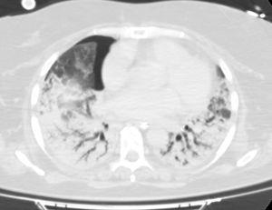Corte de la TC torácica. Pequeña cámara anterior de neumotórax. Parénquima pulmonar con broncograma aéreo.