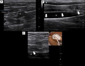 (a) The basilic vein of the arm is patent and with an optimal size for canulation (6.9mm), v. vein. (b) The guidewire is in the vein lumen (arrows); v. vein. (c) The catheter tip lies in the axillary vein (arrow); v: vein.