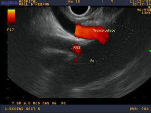 Desde la unión gastroesofágica se puede visualizar el tronco celíaco, la arteria mesentérica superior (AMS) y la aorta (Ao).