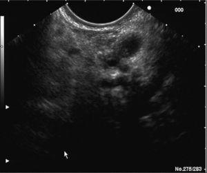 Imagen por ultrasonografía endoscópica, en la que se aprecian múltiples quistes con apariencia de «racimos de uva», localizados en la cabeza del páncreas.