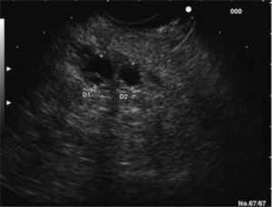 Imagen por ultrasonografía endoscópica, que muestra una afectación del conducto pancreático principal, con apariencia irregular, y la presencia de nódulos murales.