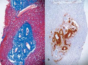 Histological appearance of hepatoportal sclerosis. a) The intrahepatic portal tracts are markedly fibrosed and expanded (Masson stain) with normal parenchymal surrounding, and b) immunohistochemical stain with anti-smooth muscle antibodies showing aberrant portal vessel with marked medial muscular hypertrophy.