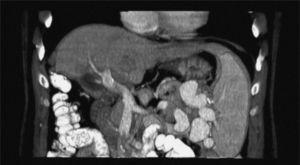 Abdominal spiral computerized tomography and tridimensional reconstruction showing a severe liver atrophy, enhanced portal vein without thrombus but reduced portal branches; splenomegaly and a great network of portal systemic collaterals were evident.
