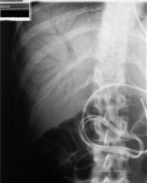 Radiografía simple de abdomen tras colocación de sonda. Imágenes aéreas ramificadas en área hepática.