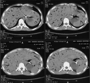 Tomografía computarizada abdominal. gas en el sistema venoso portal y esplénico.