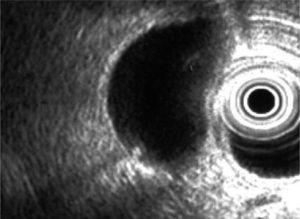 Imagen ecoendoscópica de pequeña litiasis en el interior de la vesícula, no visible por ecografía transabdominal.