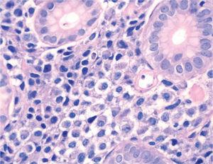 Infiltración masiva de la lámina propia por células redondeadas de hábito plasmocitoide, con un citoplasma finamente granular, núcleos redondeados u ovoides y halo perinuclear (Giemsa ×400).