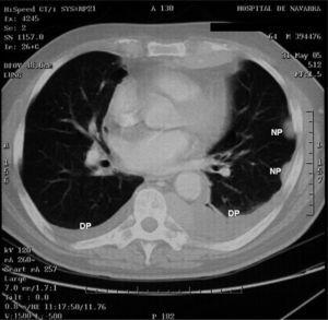 Imagen de tomografía computarizada en la que se observan 2 nódulos pleurales (NP) izquierdos, junto con derrame pleural (DP) bilateral.
