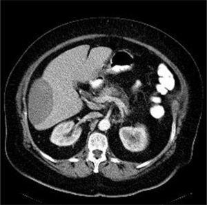 Tomografía computarizada abdominal: colección hipodensa, subcapsular, en el lóbulo hepático derecho de 14 × 8 × 5 cm.