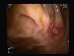 Detalle endoscópico de una de las lesiones maculopapulosas, eritematosas y con centro de fibrina a nivel del polo cecal.