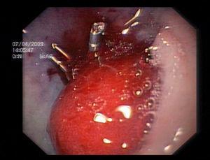 Hematoma duodenal y hemorragia de bajo volumen en la segunda gastroduodenoscopia.