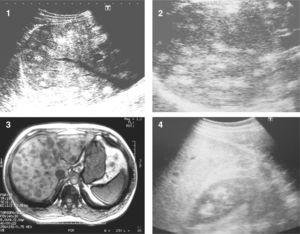 1 and 2: Axial US images of patients 1 and 2. Multiple hyperechoic nodular lesions. 3: Hypointense nodules in “opposed phase” (fat suppression) MRI, patient 2. 4: US 18 months after treatment. Diffuse steatosis without nodules, patient 1.