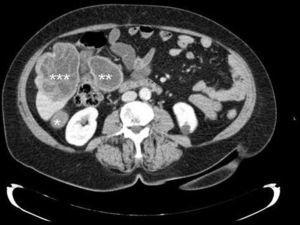 Tomografía computarizada abdominal: quistes hidatídicos pararrenal anterior derecho (*), paraduodenal (**) y hepático multiseptado localizado en los segmentos V y VI (***).