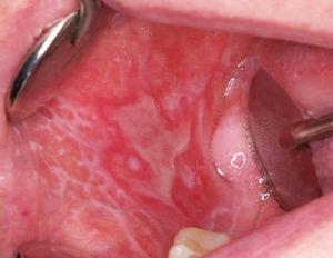 Lesiones erosivas con bordes bien definidos en la mucosa yugal.