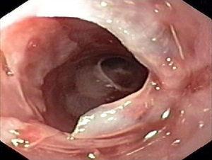 Mucosa esofágica friable y ulcerada con seudomembranas superficiales que se desprenden fácilmente.