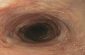 Gastroscopia tras el tratamiento con rituximab que muestra una mucosa de aspecto cicatricial.