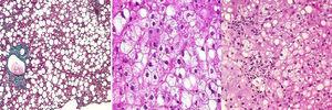 Hallazgos histopatológicos: acumulación de esteatosis en el hepatocito, inflamación lobulillar y degeneración balonizante.