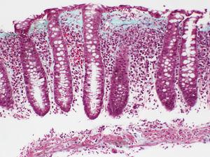 Colitis colágena. Mucosa con estructura de criptas preservada, mostrando aumento de celularidad inflamatoria de lámina propia. Banda colágena densa debajo del epitelio de superficie englobando capilares superficiales, con límite inferior irregular.