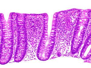 Colitis linfocítica. Mucosa con estructura preservada, con aumento de la celularidad inflamatoria en lámina propia, sin acumulación subepitelial de colágeno, donde se aprecia daño y desestructuración del epitelio de superficie, con marcada exocitosis linfocitaria transepitelial.