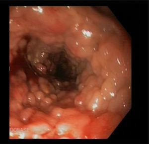Afectación mucosa en la colonoscopia diagnóstica que inicialmente hace sospechar de una poliposis hereditaria.