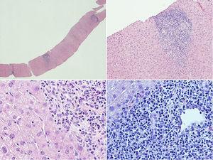 Liver histological examination. The liver tissue specimen, with a sufficient number of portal spaces, show a moderate lymphoplasmacytic inflammatory infiltrate with poor eosinophilic component; bile ducts were attacked in several tracts by lymphocytic cells with evidence of interface hepatitis and ductular proliferations. No evidence of significant fibrosis.