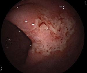 Mucosa colónica con ulceración plana y superficial, compatible inicialmente con colitis isquémica.