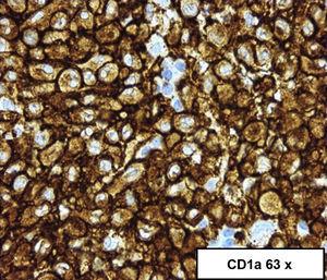 Células redondeadas con hábito histiocitario con mínima atípica y tinción CD1a positivo.