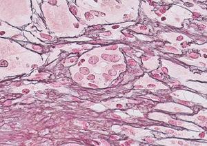 Biopsia hepática: formación de «rosetas». Tinción Hematoxilina-eosina a 40x.
