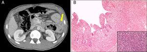 A: TAC abdominal en el que se muestra la perforación intestinal a nivel yeyuno (flecha). 1B: análisis histológico del asa de yeyuno resecada quirúrgicamente.