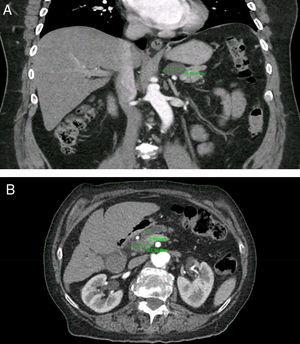 Prevalence Of Incidental Clinically Relevant Pancreatic Cysts At Diagnosis Based On Current Guidelines Gastroenterologia Y Hepatologia