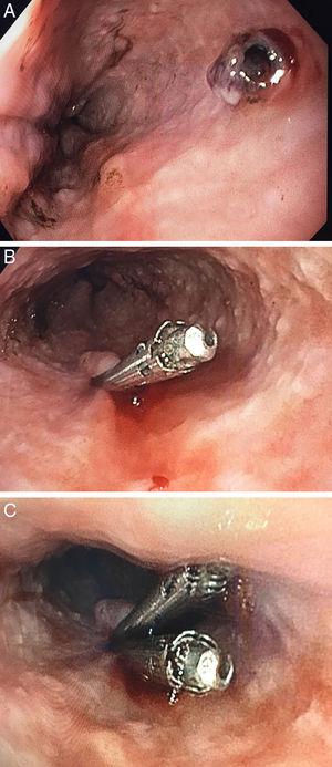 Imágenes de una endoscopia. A) Vaso visible en tercio medio esofágico con mucosa normal. B) Hemostasia endoscópica con Hemoclip®. C) Hemostasia endoscópica con Hemoclip®.