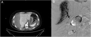 A) TC: imagen con hallazgo de un hematoma subcapsular hepático de 100×120×190mm. B) Arteriografía: tratamiento mediante embolización vascular.