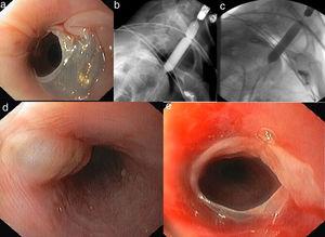 Endoscopic findings disclose (a) esophageal stricture due to a translucent membrane at 20cm below the incisor. (b) The 12-mm-diameter balloon was placed at the stricture. (c) Inflation of the balloon until the disappearance of the waist. Endoscopic findings showing (d) esophageal blister and (e) denude mucosa after minor trauma induced by the procedure.
