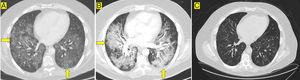 TAC torácica. Evolución radiológica de la afectación pulmonar intersticial.