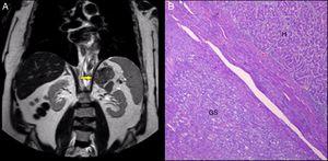 A) RM de la metástasis en la glándula suprarrenal izquierda (flecha). B) Tinción hematoxilina-eosina de la metástasis del hepatocarcinoma (H) junto al tejido suprarrenal normal (GS).