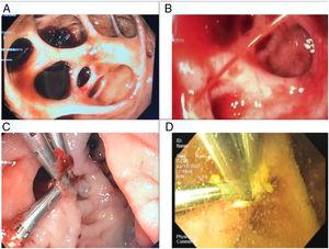 (A) UE revealing blood in the giant DD; (B) during observation, an arterial spurting of the DD was seen; (C) the bleeding was controlled with epinephrine and 3 hemoclips; (D) a second look endoscopy was performed without evidence of rebleeding.