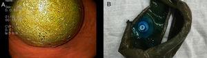 (A) Upper endoscopy showing fungal colonization of the intragastric balloon. (B) Extracted intragastric balloon.