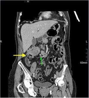 Sección coronal de la TC que muestra la invaginación intestinal (flecha grande) y una adenopatía regional (flecha pequeña).