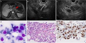 Heterogeneous mass arising from the pancreatic body and extending to the retroperitoneum, observed in abdominal magnetic resonance (A) and EUS (B). The lesion was punctured through EUS-FNA (25G). Cytopathology showed cells with large granular cytoplasm and prominent nuclei (A+B). Immunohistochemistry was strongly positive for CD 34 (C) but also for CD 68, vimentin and CD 71. These findings allowed the diagnosis of myeloid sarcoma.