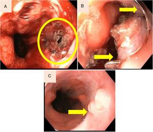 (A) Laceration of the oesophagogastric junction. (B) Disruption resolved with placement of over-the-scope clip (OTSC). (C) Endoscopic control demonstrated no clip and granulation formation at the laceration site.