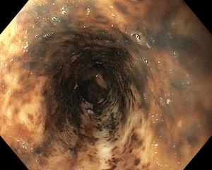Imagen endoscópica de esófago medio en la que se observa mucosa esofágica necrótica que se extiende proximalmente desde el esófago distal.