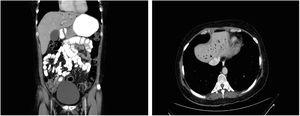 Computed tomography (CT)-scan images at diagnosis of HPVG. (a) Axial reconstruction. (b) Coronal reconstruction. Portal vein gas is predominantly located within the left hepatic lobe in both CT-scan images. Air bubbles appear to extend within 2cm of the liver capsule.