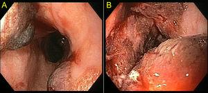 Gastroscopia en la que se identifican múltiples vesículas (A) con una mucosa ulcerada en el tercio inferior esofágico (B).