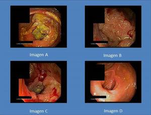 La imagen A muestra el pseudotumor en la primera colonoscopia realizada. Las imágenes B y C muestra la lesión en la segunda colonoscopia. La imagen D muestra la curación mucosa tras el tratamiento antiviral.