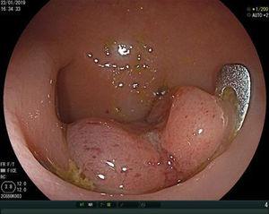 Endoscopic clipping of the rectal perforation with 15mm OVESCO.