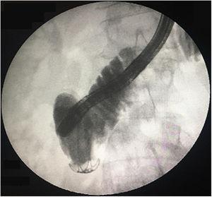 Final opacification showing no extravasation of contrast after perforation closure with an over-the-scope-clip.