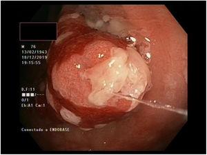 Visión ampliada de una de las lesiones de gran tamaño, donde se puede observar la mucosa eritematosa con el epitelio descamativo blanquecino en su superficie.